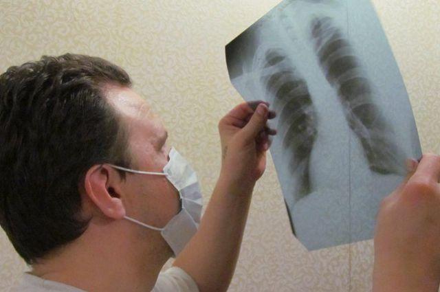 Десятки людей в Молдове ежедневно заболевают туберкулёзом