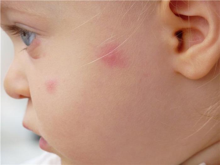 В Молдове участились случаи обращения к врачам с аллергией на укусы комаров
