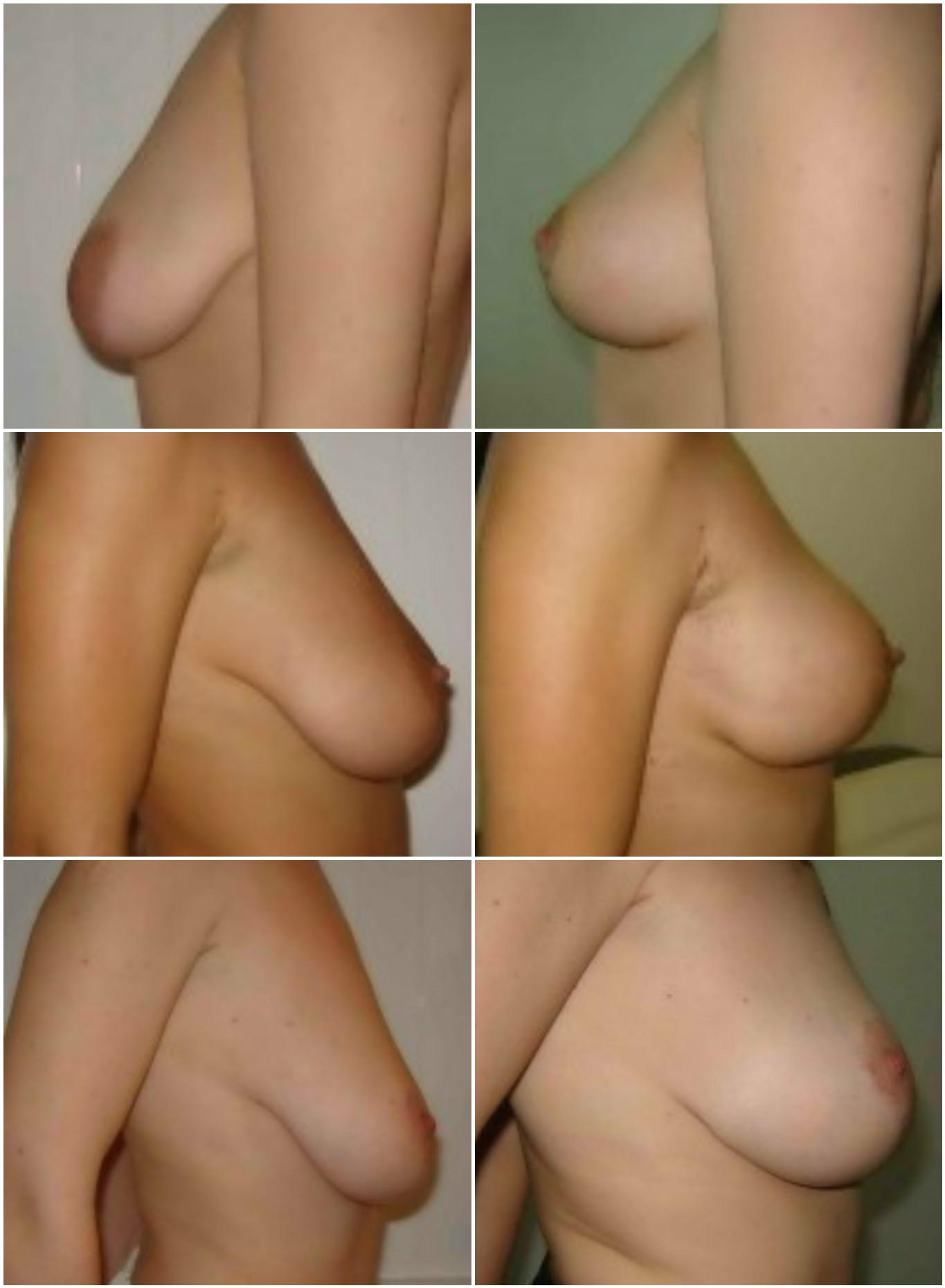 Micșorarea sânilor prin reducția pielii și repoziționarea complexului areolă-mamelon