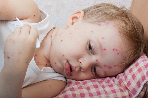 Cu ce tratăm varicela la copii pe lângă verdele de briliant: metode moderne și eficiente