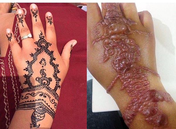 Și-a făcut tatuaj cu hennă și a rămas cu cicatrici pentru toată viața!