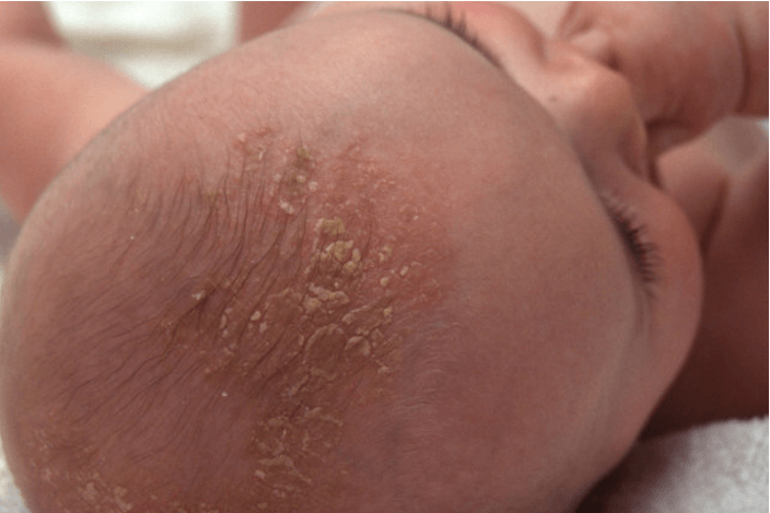 Dermatita seboreică la copii – modalități eficiente de a o înlătura