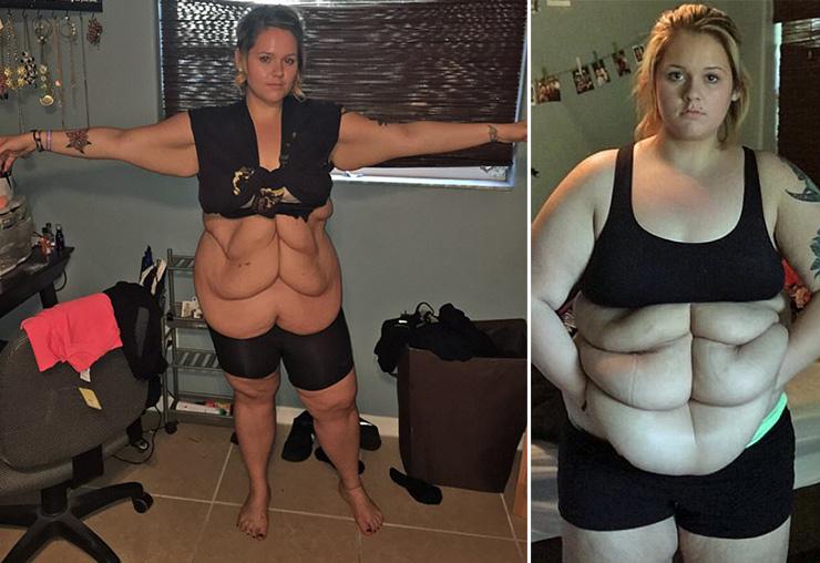 6 пакетов лишней кожи: американка похудела на 80 килограммов и поделилась фото