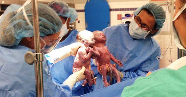 Cum arată acum gemenele care s-au născut ținându-se de mână