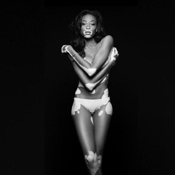 Supermodelul cu vitiligo Winnie Harlow a pozat topless