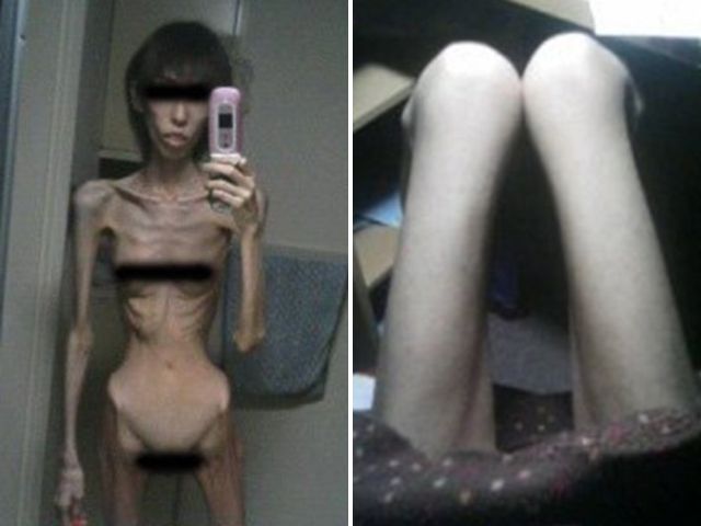 Японка, которая весила 17 килограммов, показала свои фото