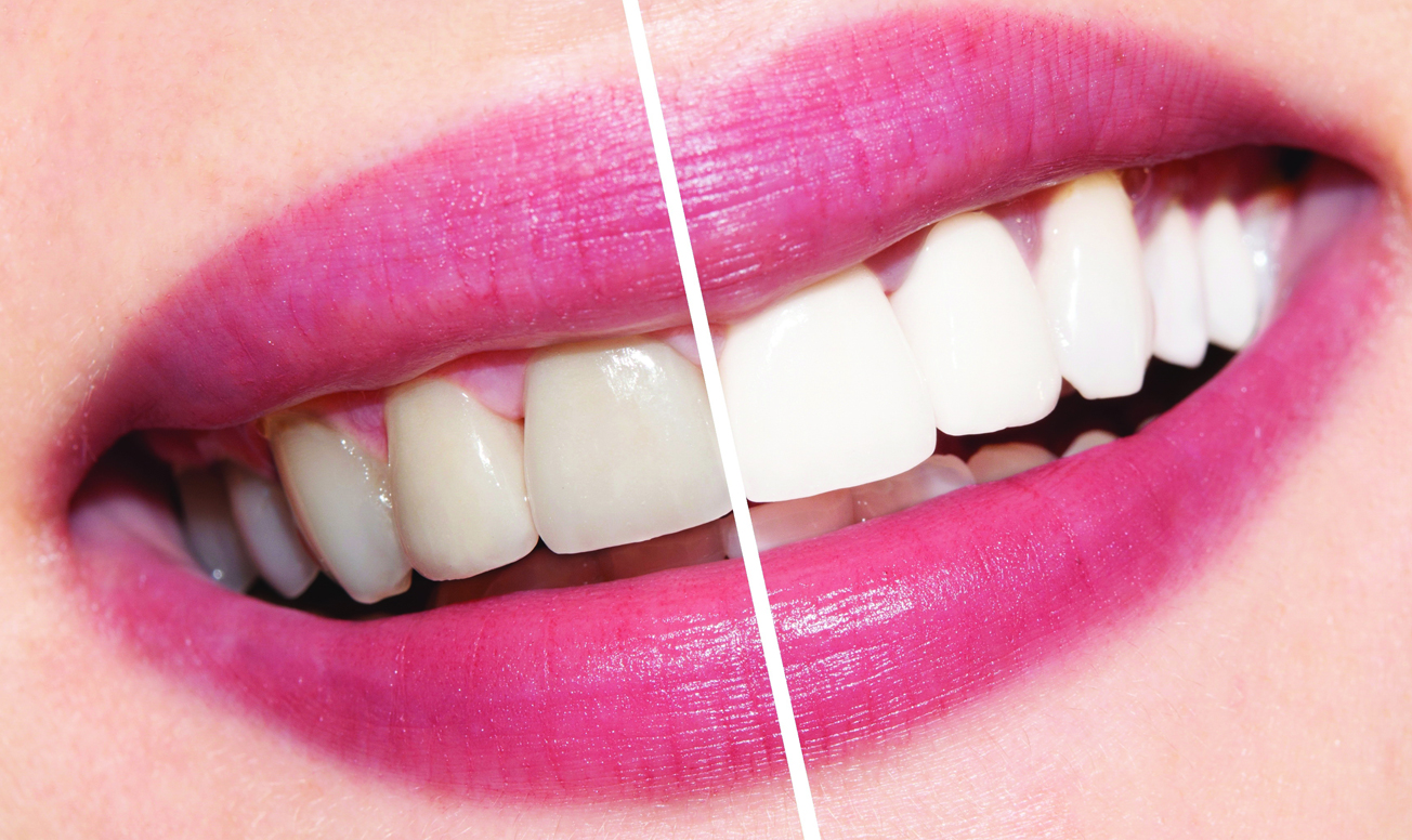 4 metode eficiente prin care îți poți albi dinții acasă în mod natural
