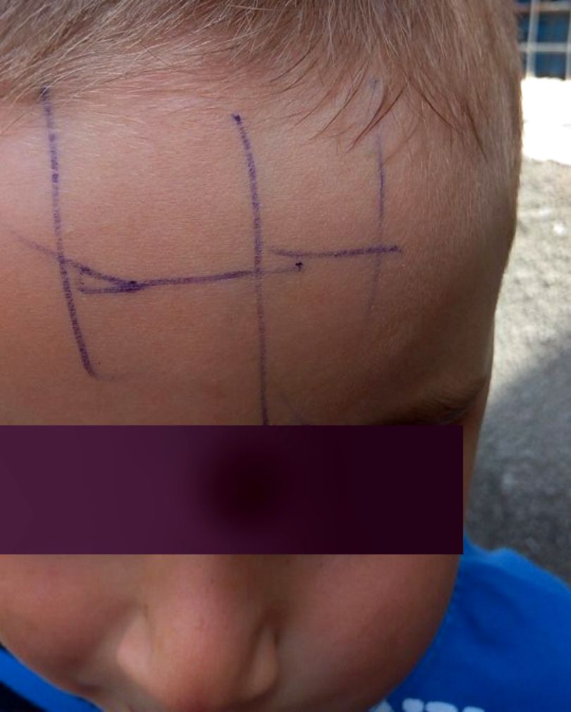 ȘOCANT. O educatoare a scris cu pixul pe fruntea unui copil de patru ani