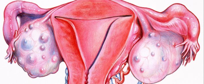 Ce trebuie să știe o femeie despre chisturile ovariene