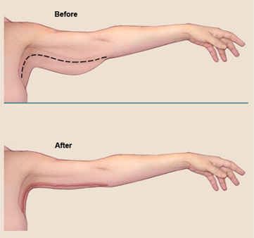 Cum puteți scăpa de pielea întinsă și lăsată din zona brațelor