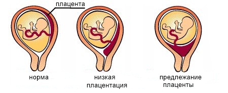 Предлежание плаценты: тактика ведения беременности и родов