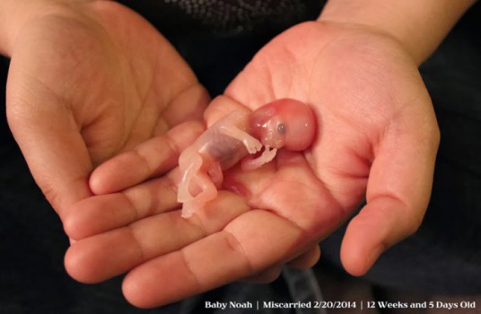 Fotografia unui bebeluş avortat la trei luni îl salvează pe altul de la avort