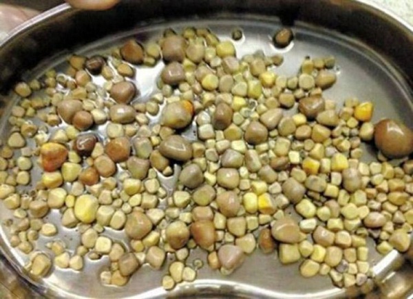 Неотложная операция: у любителя тофу удалили 420 камней из почек