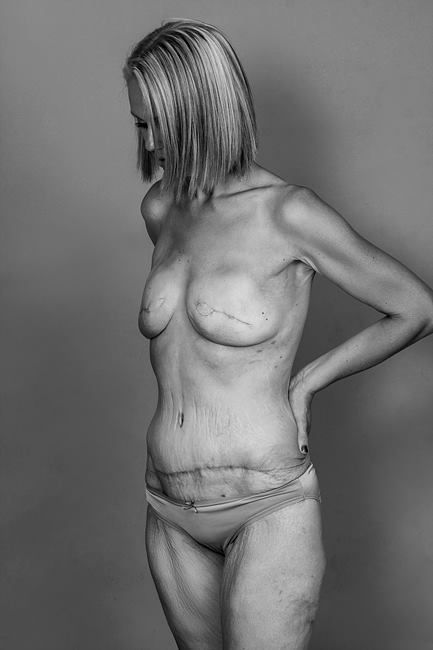 Женщина показала фото после мастэктомии, и от нее отписались 100 друзей