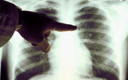 В РМ из-за халатности врача 59 детей заразились туберкулезом