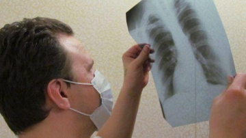 Десятки людей в Молдове ежедневно заболевают туберкулёзом