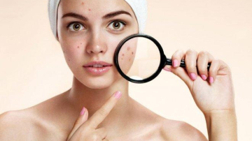 О чем говорят высыпания на лице: карта прыщей и болезней