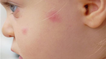 В Молдове участились случаи обращения к врачам с аллергией на укусы комаров