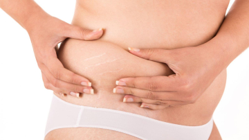 Slăbitul rapid – o cauză a vergeturilor! Cum le putem combate?