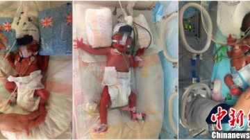 Китаянка родила тройняшек с интервалом в шесть дней