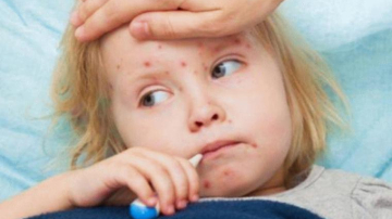 OMS: România e principalul focar de rujeolă din Europa