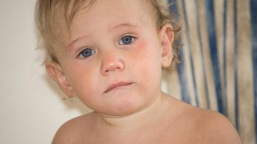 5 мифов о детской аллергии