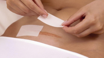 Уход после кесарева сечения