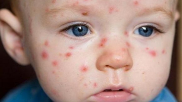 Boala mână-picior-gură: cum se manifestă și cât este de răspândită în Moldova