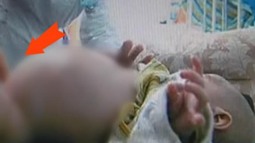 Fenomen medical uimitor! Copil care îl purta în pântec pe geamănul său