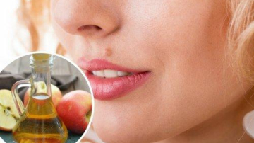 Știai că poți îndepărta alunițele în mod natural? Vezi 8 remedii eficiente