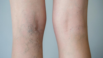 Cum să scapi de varice în două săptămâni? Leacul natural care face minuni