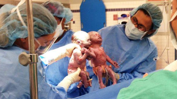 Cum arată acum gemenele care s-au născut ținându-se de mână