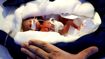 Cum arată copilul care cântărea 400 de grame la naștere