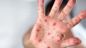 Родители в Молдове могут быть спокойны, в стране не подтвердились случаи заболевания корью