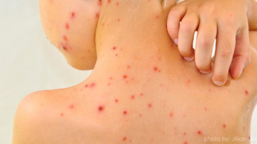 Al doilea caz de rujeolă importat din Odesa. Ministerul Sănătății atenționează părinții să-și vaccineze copii