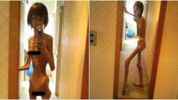 Imagini șocante. O tânără de 20 de ani a ajuns să cântărească doar 16 kilograme