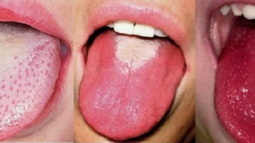 Focar de scarlatină în Chișinău. Fiți atenți la simptome