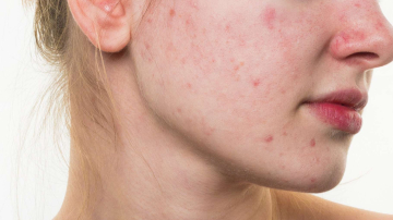 Nici nu bănuiai! Iată care ar putea fi motivul apariției acneei