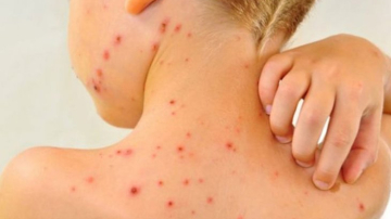 Tot mai puține cazuri de rujeolă sunt înregistrate în Moldova
