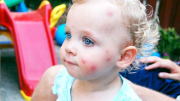 Коварные укусы и ожоги! Универсальный ключ от летних ловушек