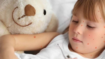 Codul portocaliu de răspândire a rujeolei va fi modificat în galben