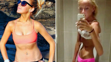 Австралийка довела себя до анорексии, чтобы быть похожей на Миранду Керр