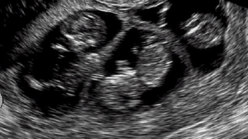 Девочка 10 месяцев дурачила семью, притворяясь беременной