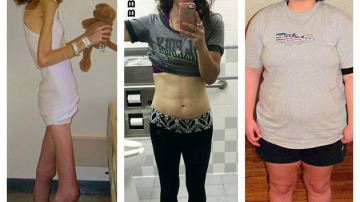 С 25 до 100: после анорексии девушка набрала 80 килограммов и снова похудела