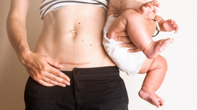 Tratamentul sigur al venelor varicoase după nașterea copilului în timpul alăptării
