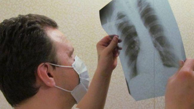 Десятки людей в Молдове ежедневно заболевают туберкулёзом