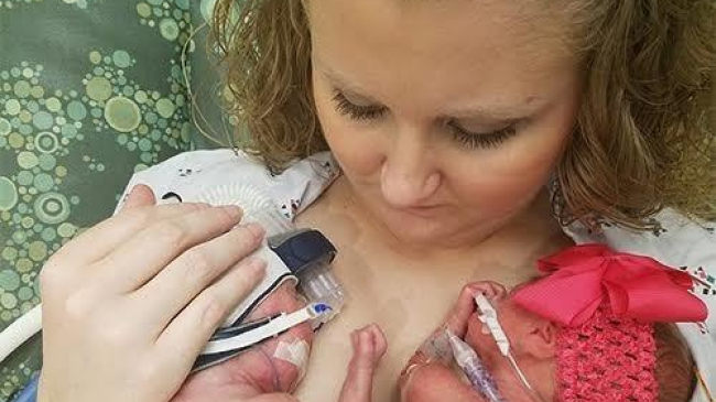 Близнецы появились на свет с разницей в пять недель