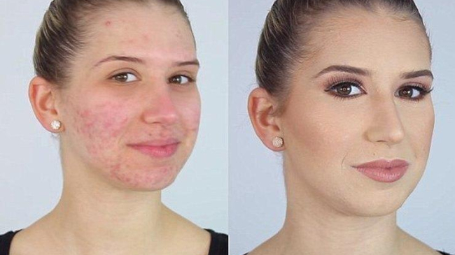 Бьюти-блогер показала фантастический способ маскировки акне зеленым консилером