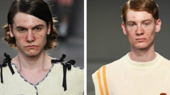 Прыщи — это круто! Модели с акне вышли на подиум на Неделе моды в Милане