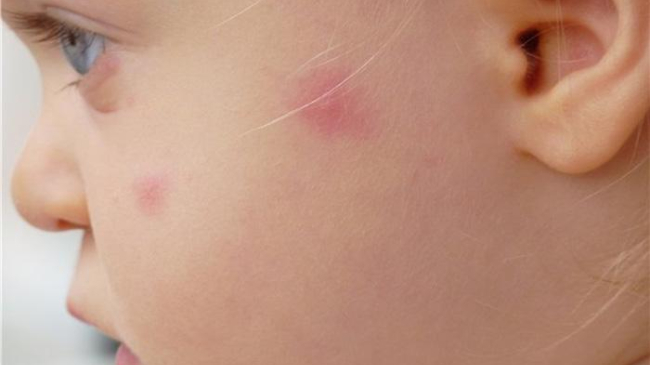 В Молдове участились случаи обращения к врачам с аллергией на укусы комаров